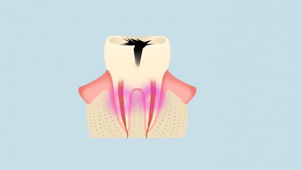 蛀牙已经烂空了怎么办