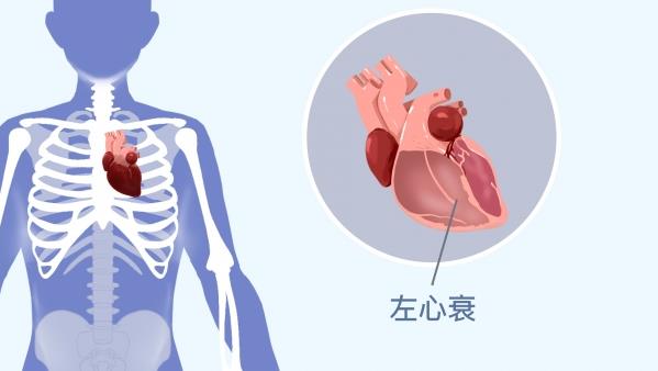 冠心病症状与预防指南，帮助你识别与防治心脏疾病