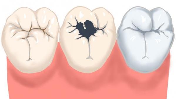 蛀牙已经烂空了怎么办