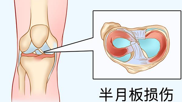 半月板撕裂如何治疗最好