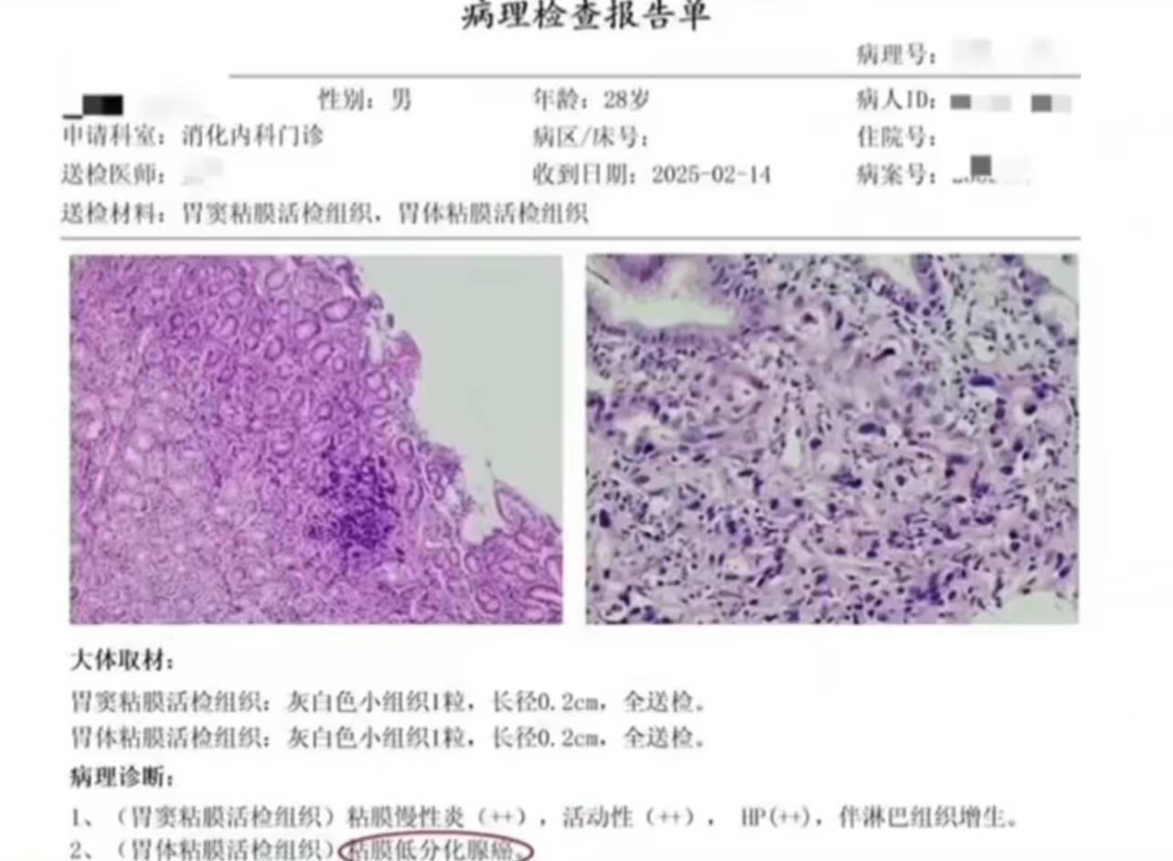 28岁小伙因熬夜导致胃癌，医生提醒熬夜的危害